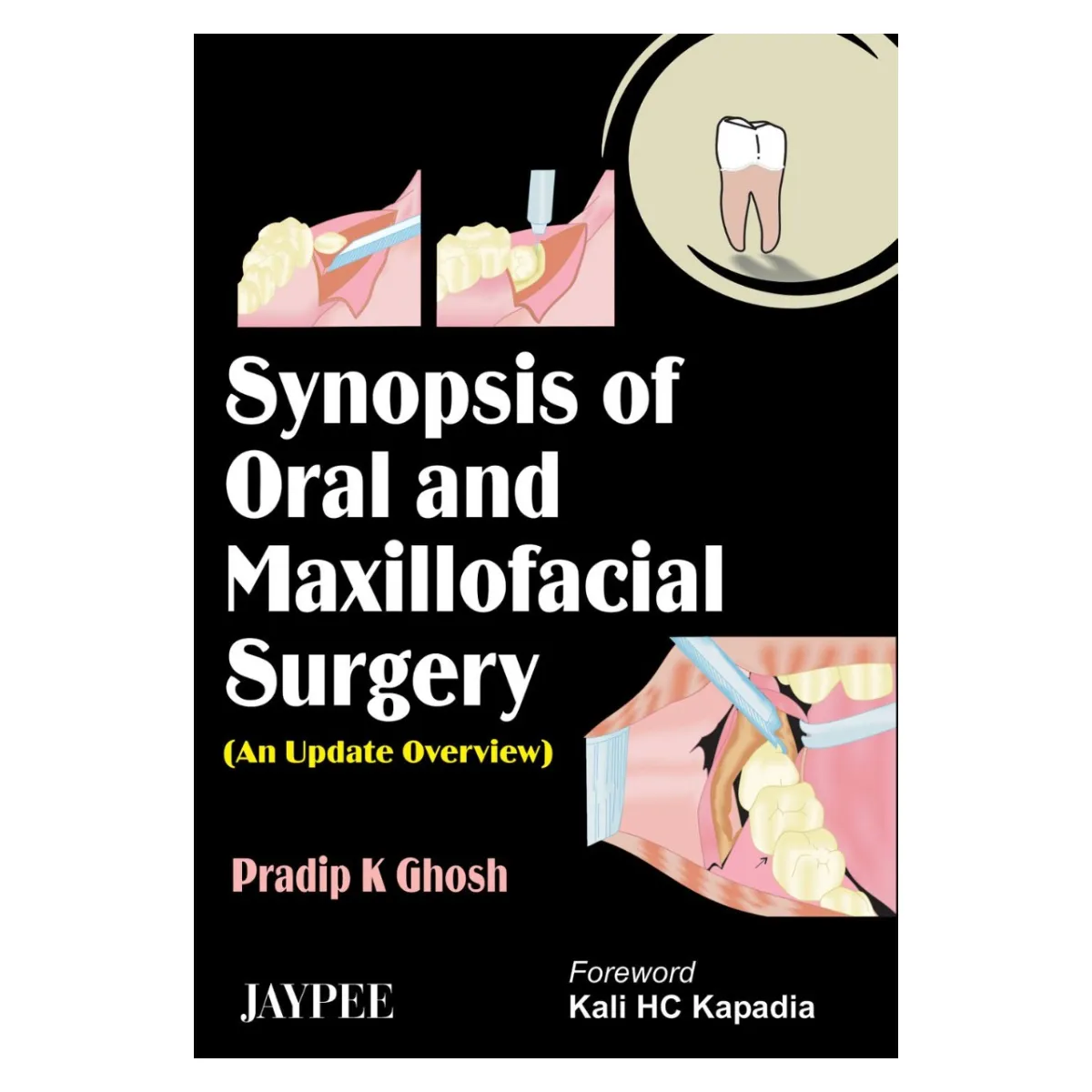 Jaypee Medical Synopsis Of Oral And Maxillofacial Surgery: An Update Overview (ISBN - 616372)