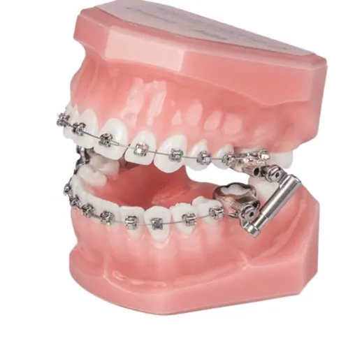 Ormco Advansync 2 Class II Corrector