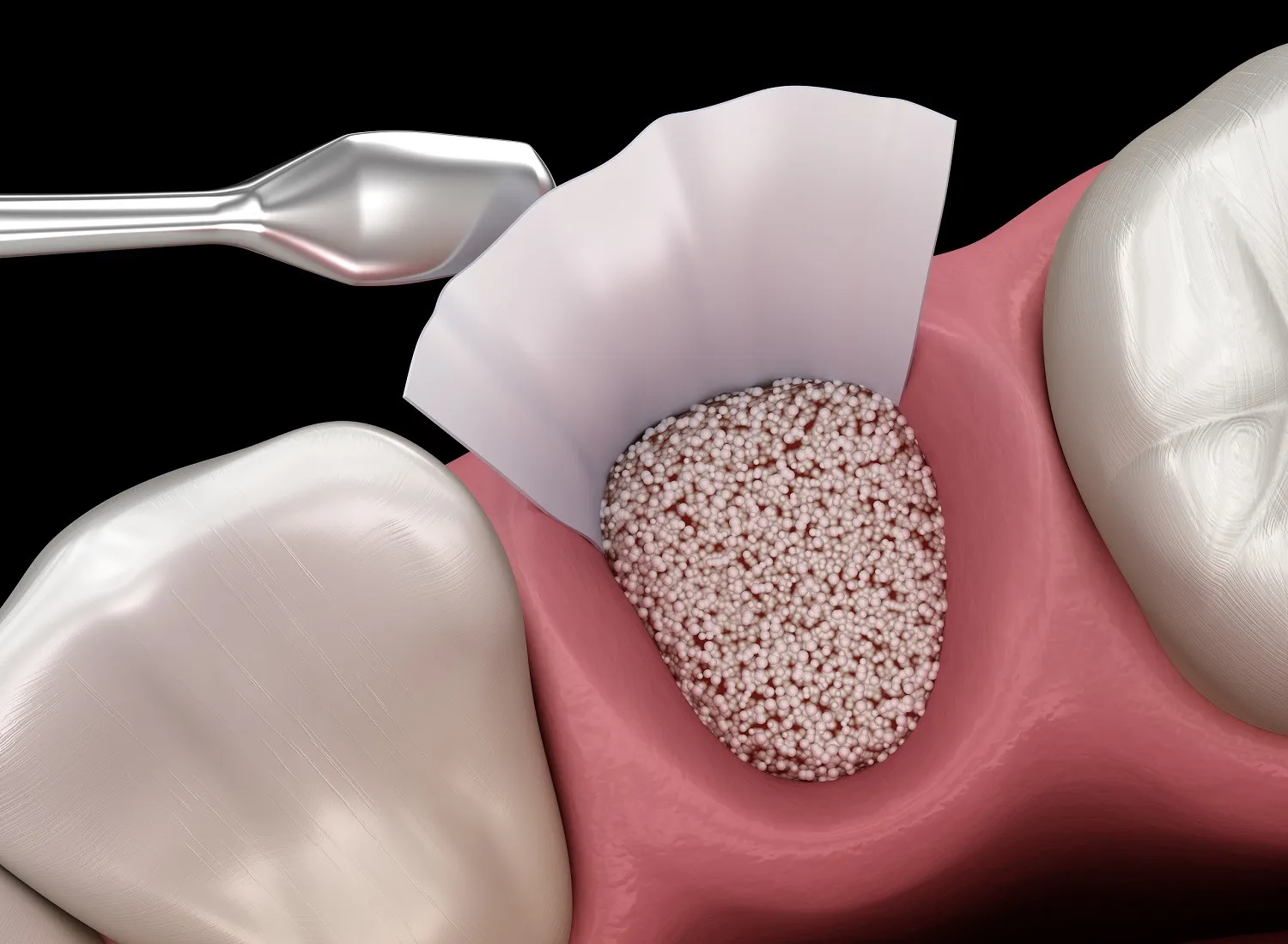 Xcem Osspore Synthetic Bone Grafts HA / B-TCP Mix In Syringe 