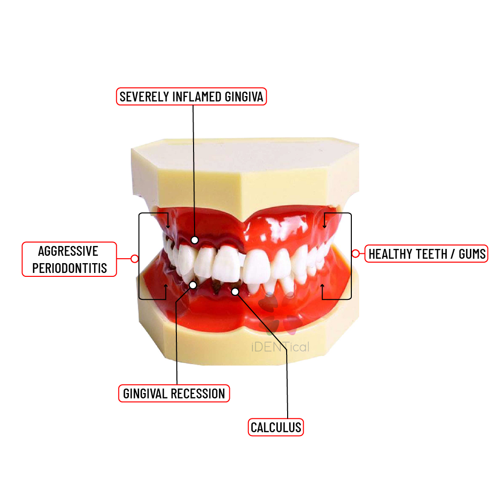 iDENTical Periodontal Disease Model M4025