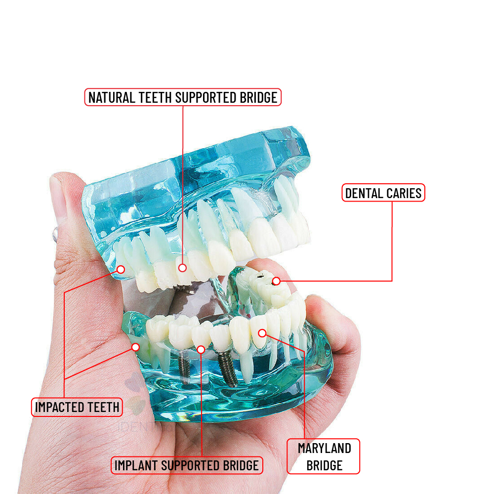 iDENTical All In One Implant Models M2001
