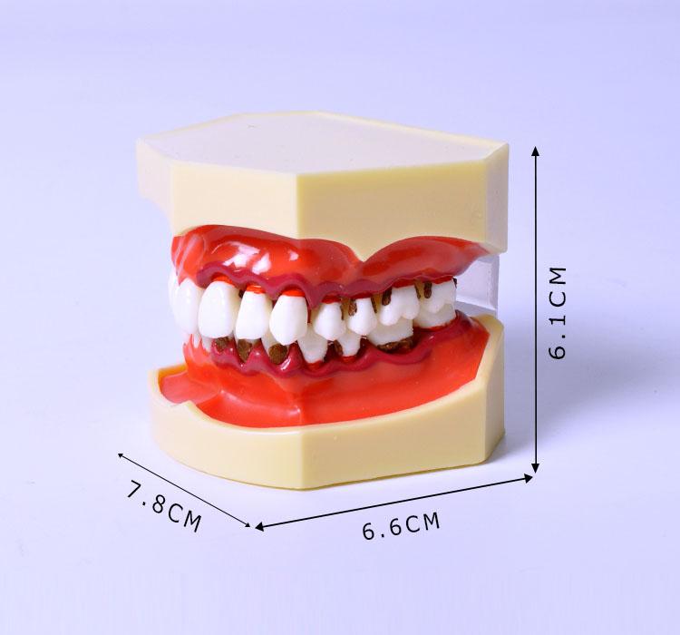 iDENTical Periodontal Disease Model M4025