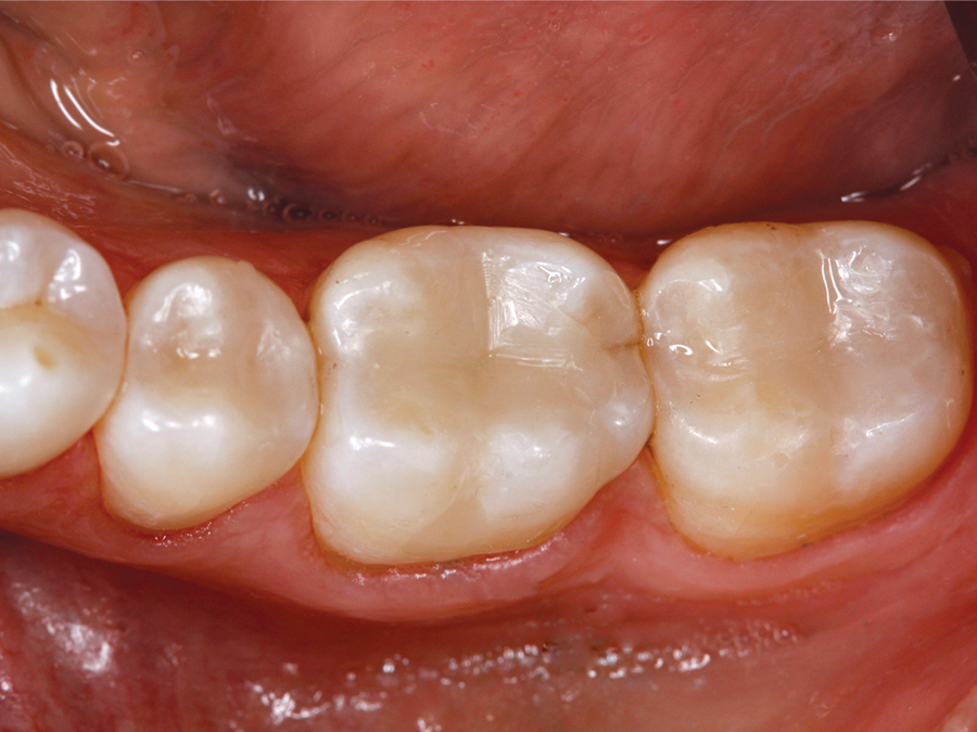 Ivoclar Tetric N-Ceram Bulk Fill Composite Syringes 3.5gm