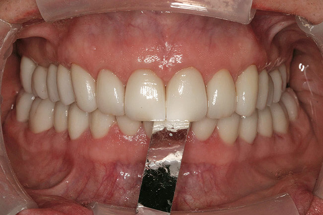 Bausch Dental Arti Fol Metallic Shimstock Flim 12µ Microns