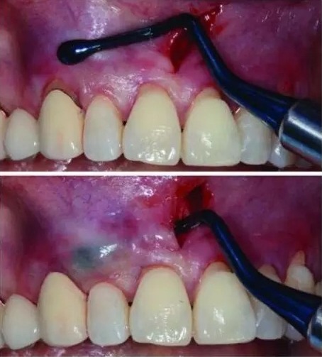 Waldent Vista Tunneling Procedure Kit Set of 6 (K22/1)