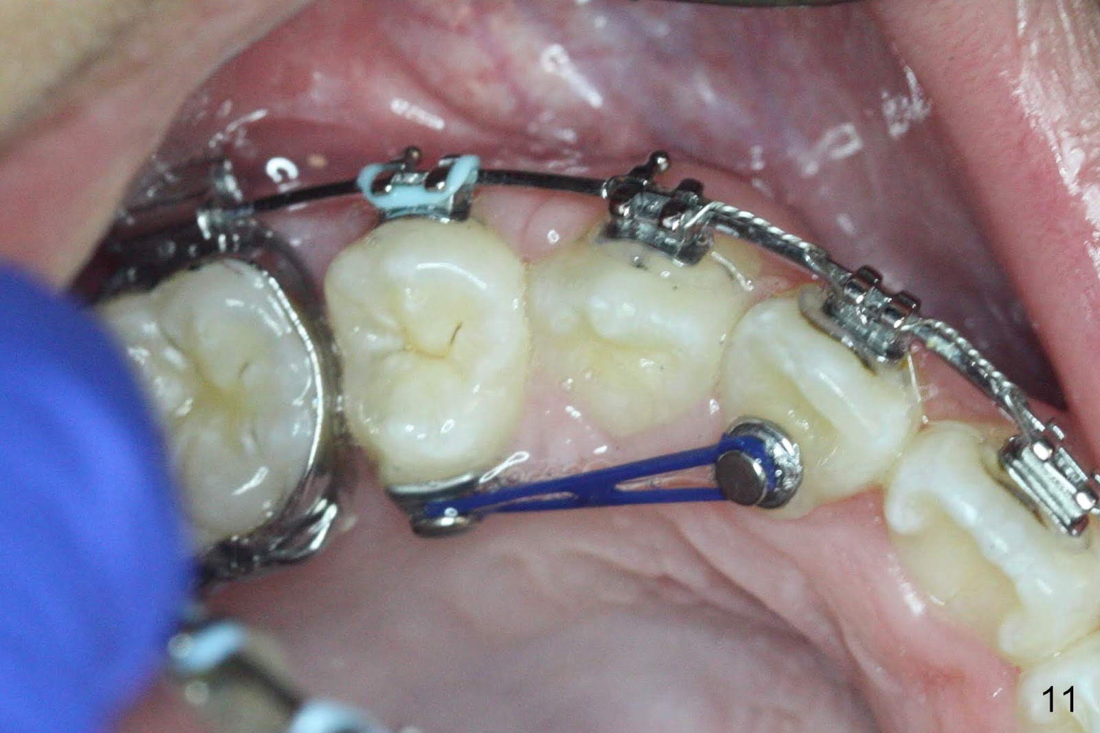 Ortho Direct Lingual Buttons