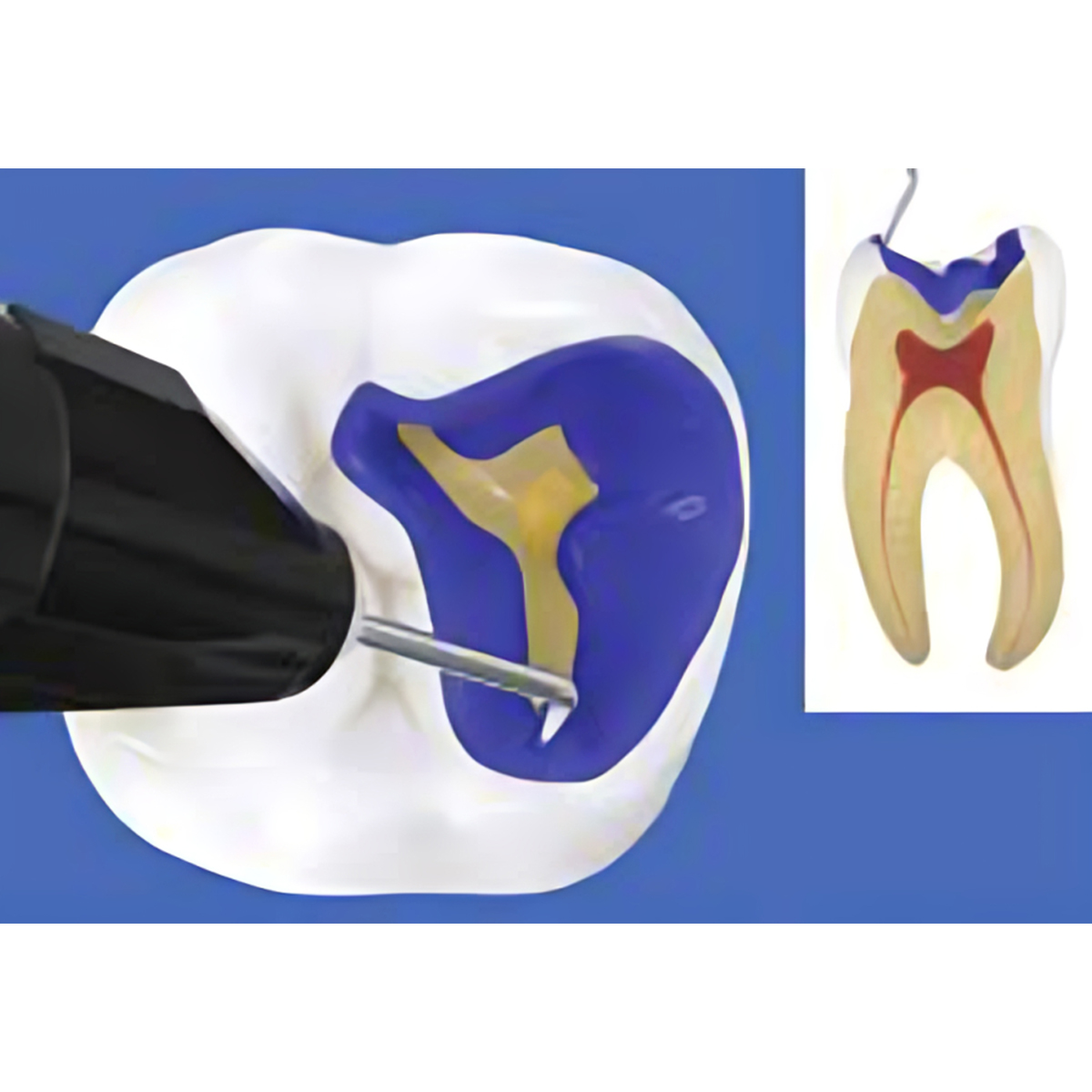 Prime Dental Restorite Cal 2gm