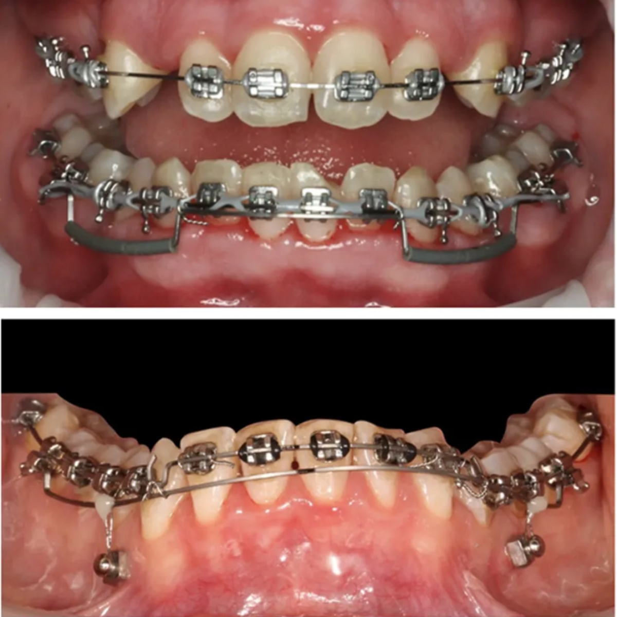 OSL NiTi Reverse Curve Archwires - Round (Pack Of 10)