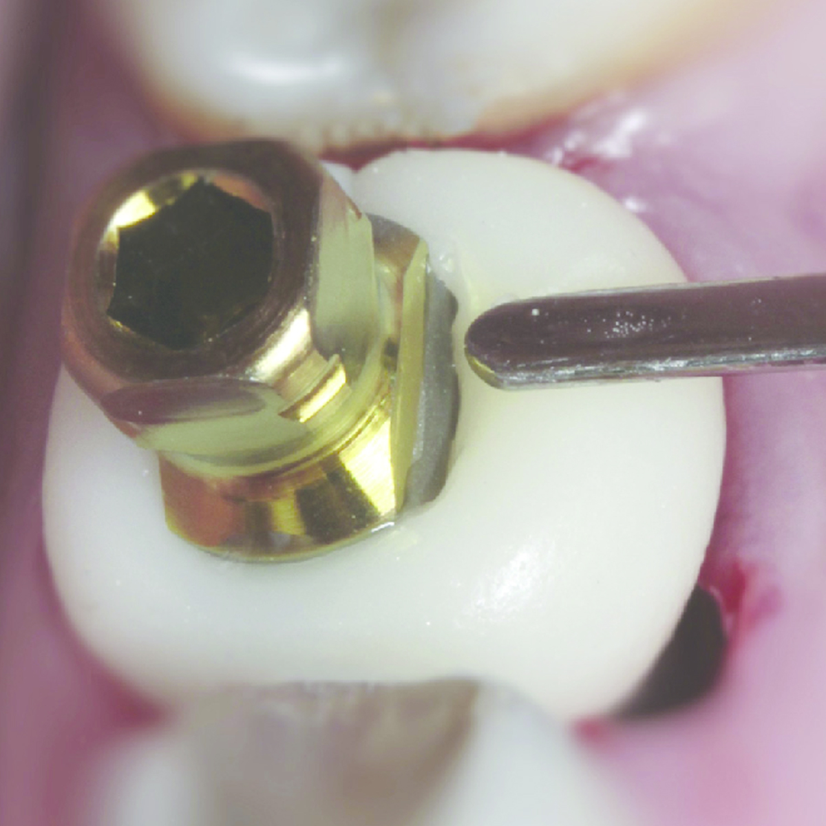 EZ Fit Noris Neo Regular Compatible Colored Titanium Abutment Screw - EZ-025A