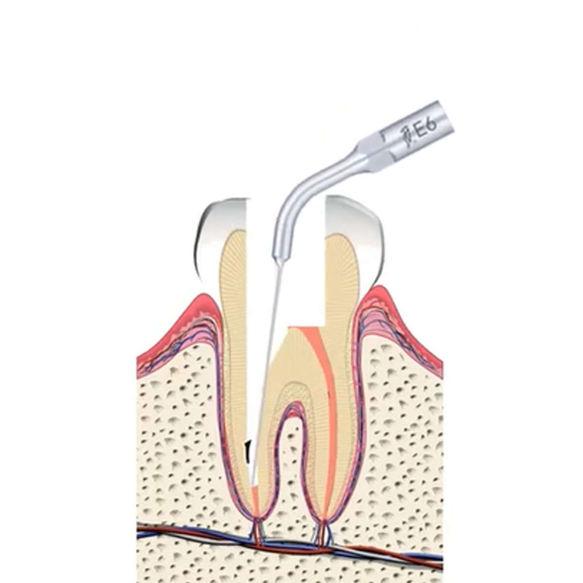 Woodpecker Scaler Tip E6 for UDS & EMS Scalers