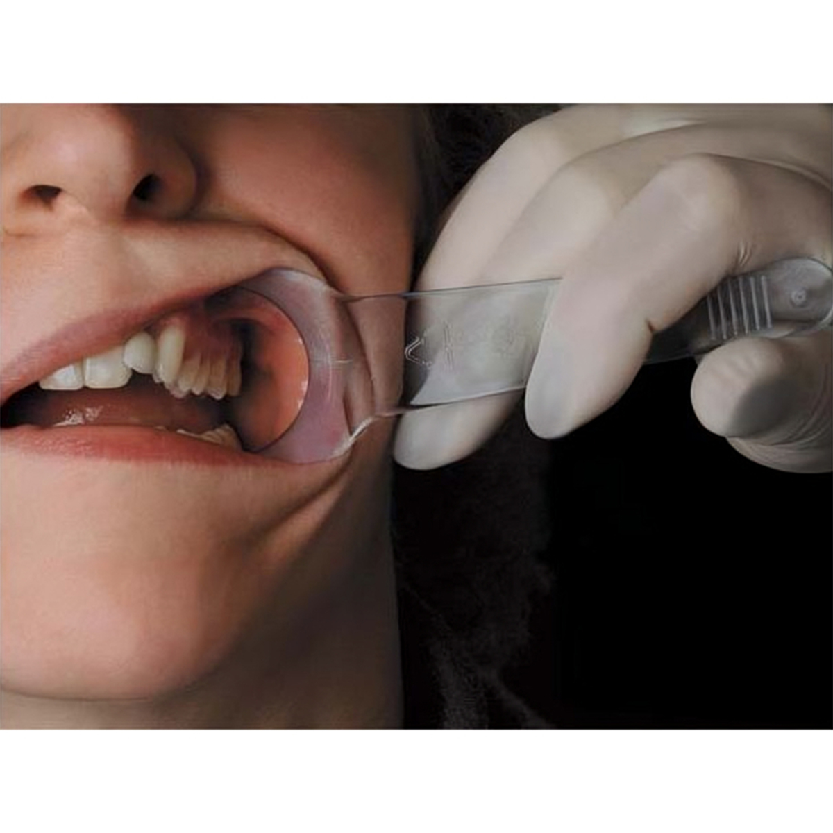 Cotisen Cheek Retractor Y Type- Large Pk/2