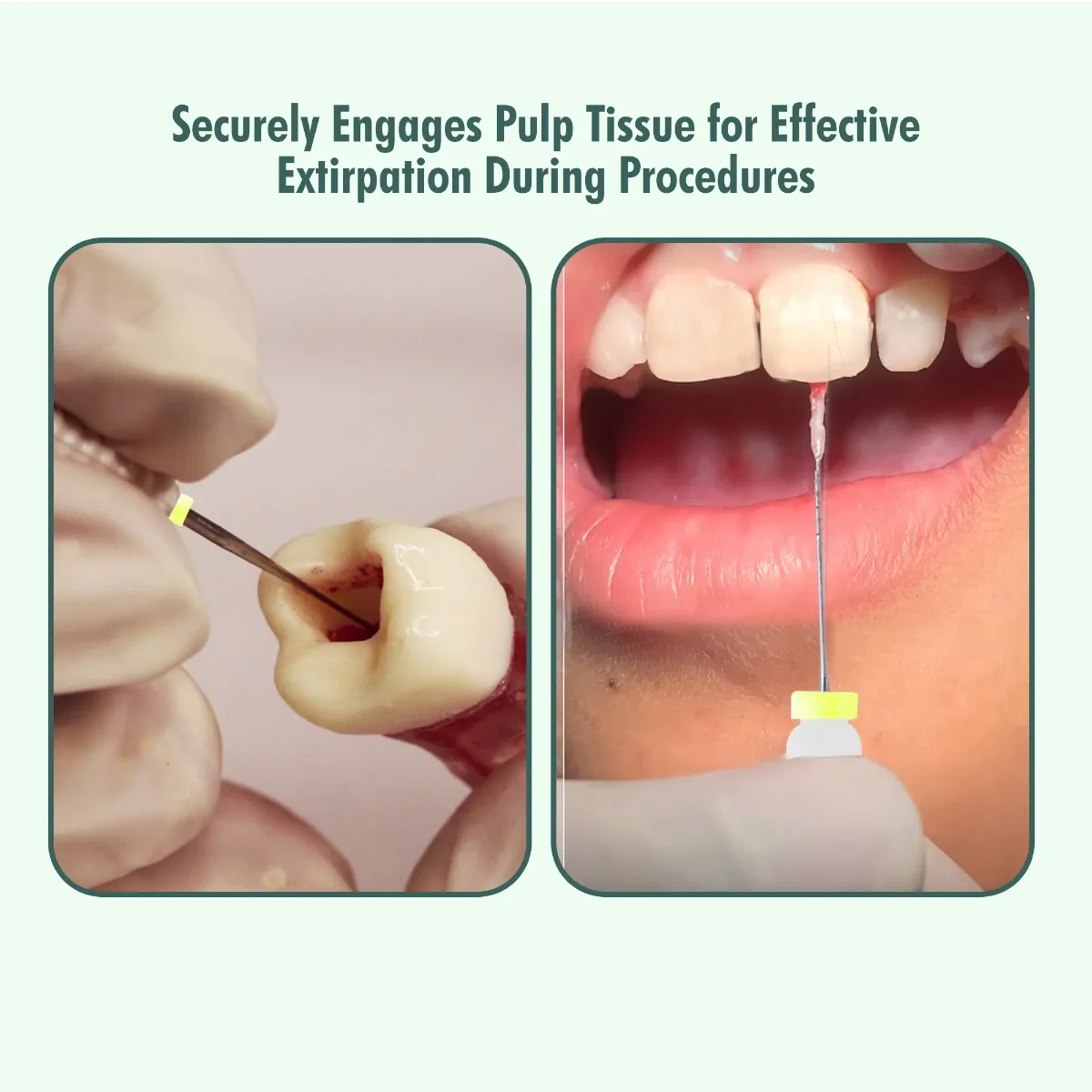 Waldent Barbed Broaches 21mm # 01-06 (Pack of 6)