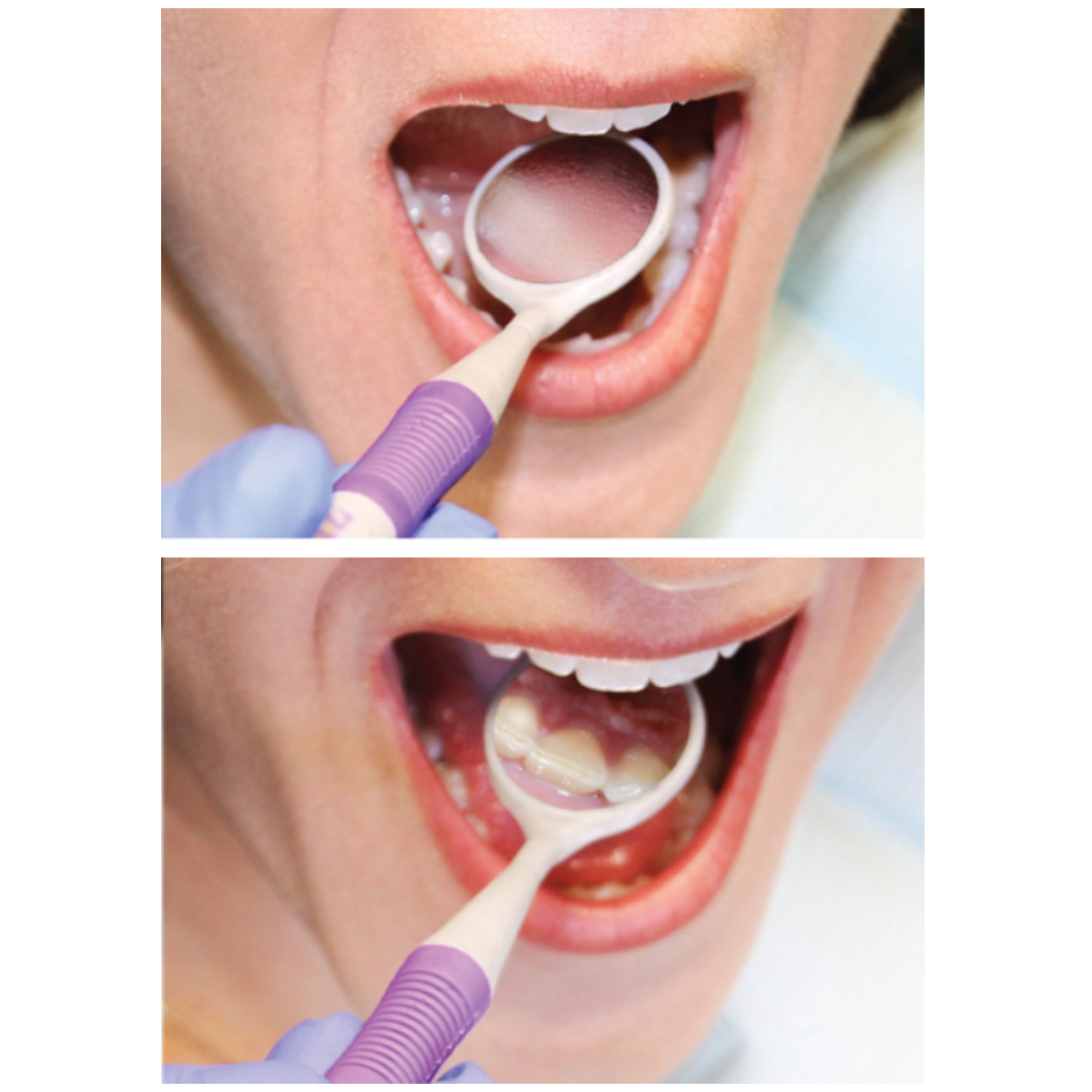 Zirc Mirror Magic Anti-Fog System Trial Kit