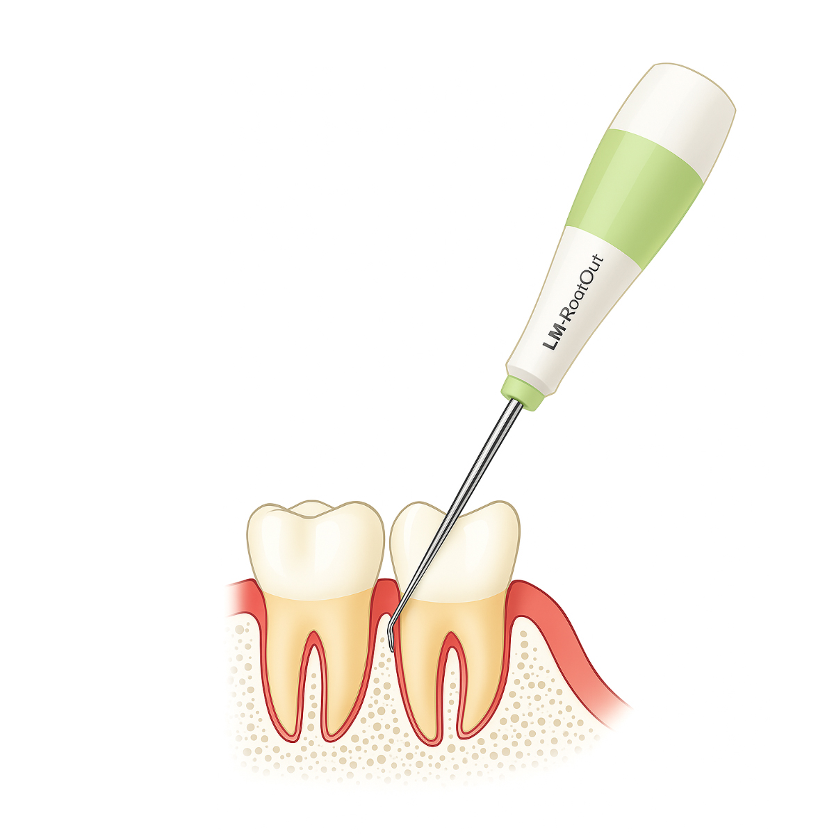 LM-RootOut|Instrument For Root Removal