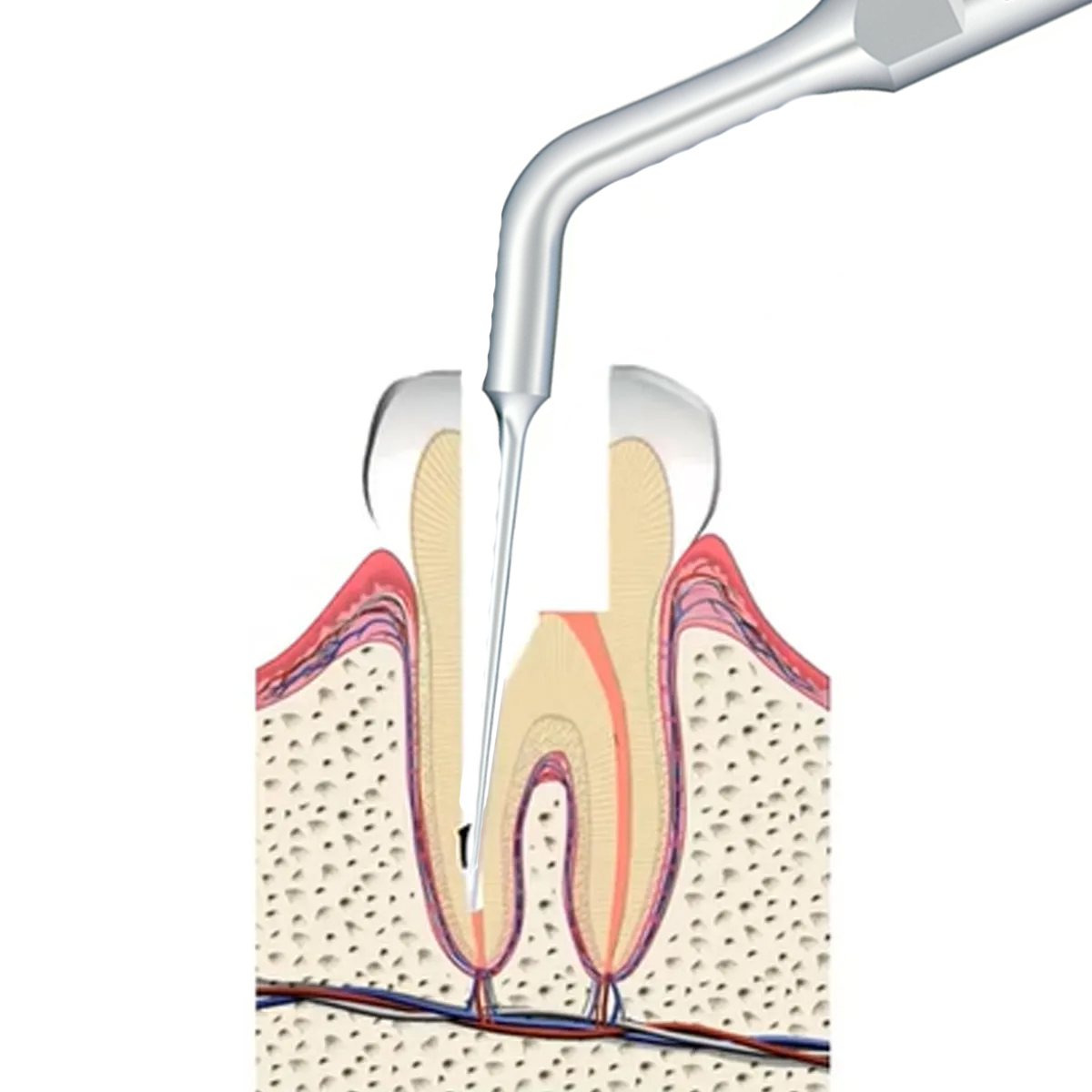 Woodpecker Scaler Tip ED7 for DTE & Satelec Scalers