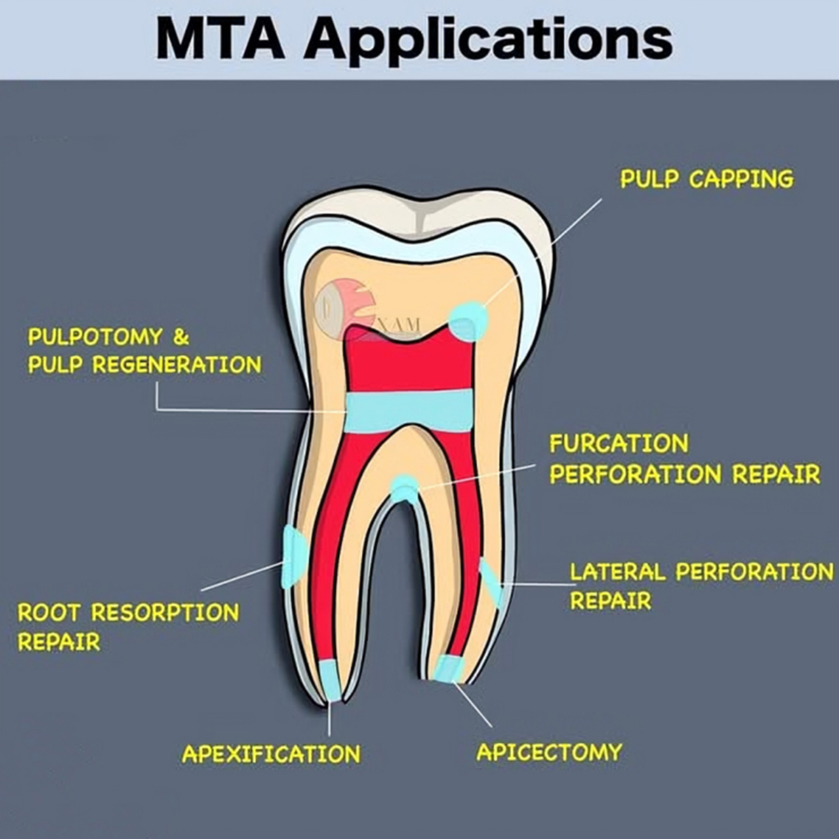 Prime Dental Prime MTA Packable