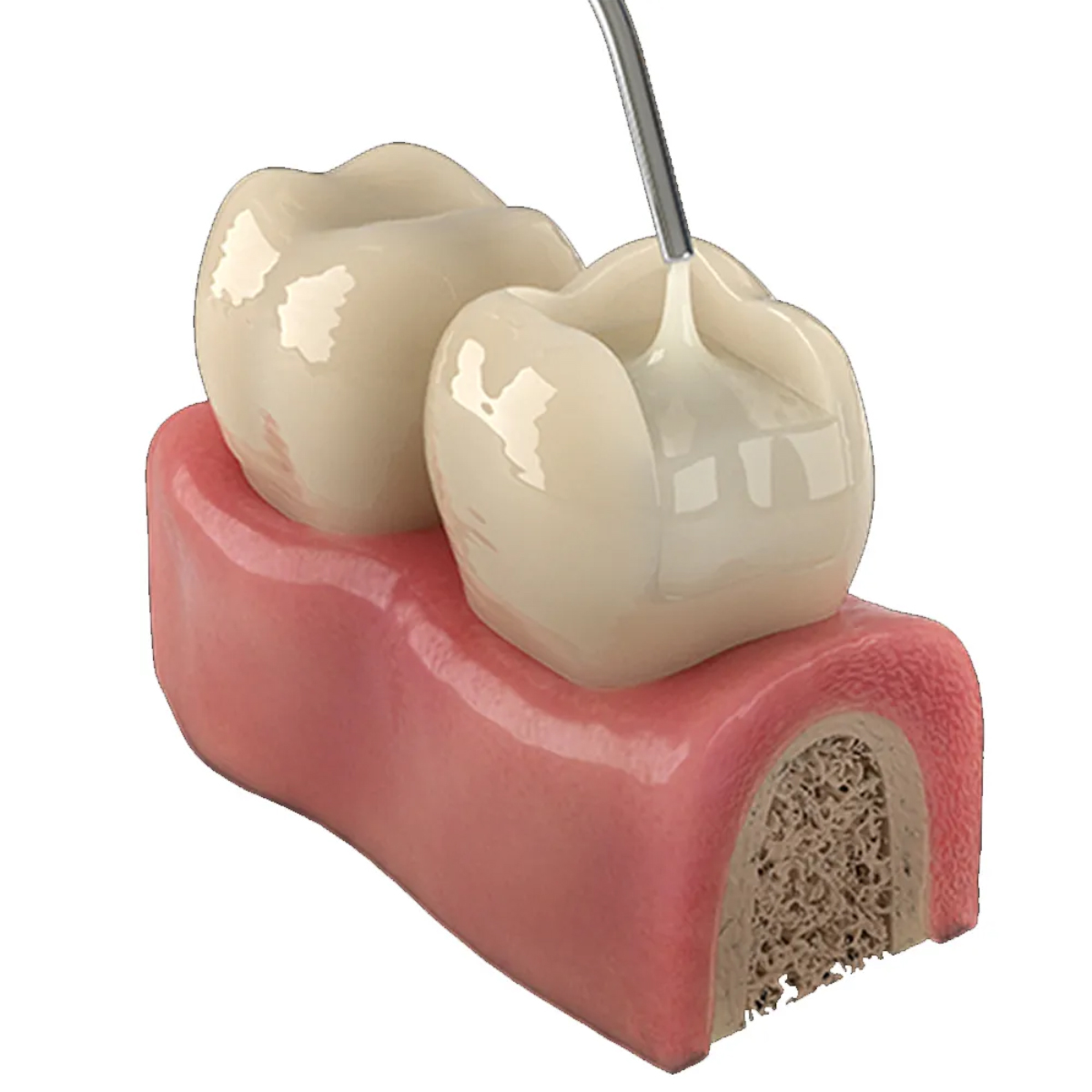 Wizdent Master Design Restorative Composite Refills