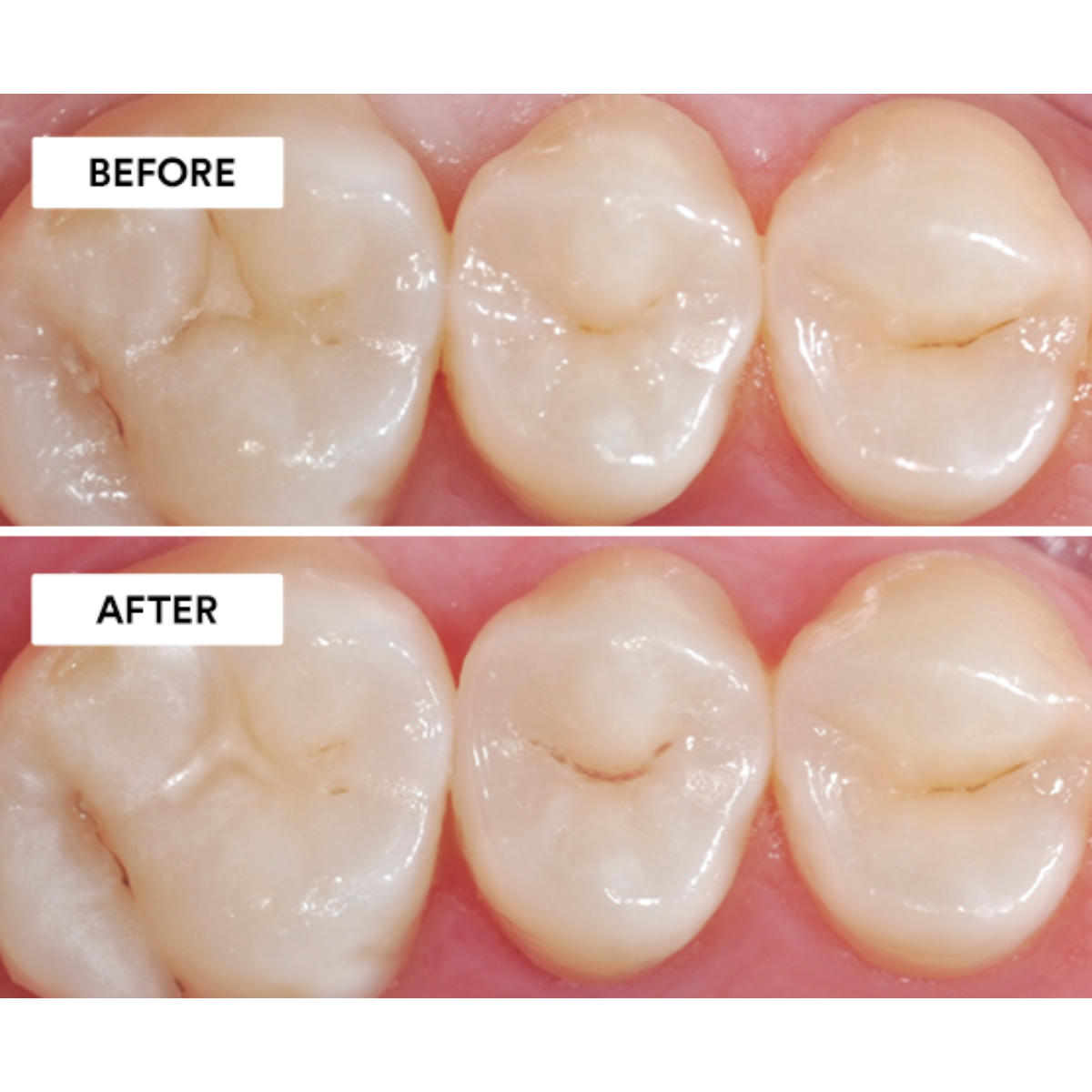 Wizdent Secure Lute RMGI Luting GIC Liquid