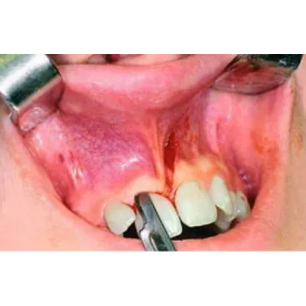 Hmd Glass Van Sterile Surgical Blade (Pack Of 100)