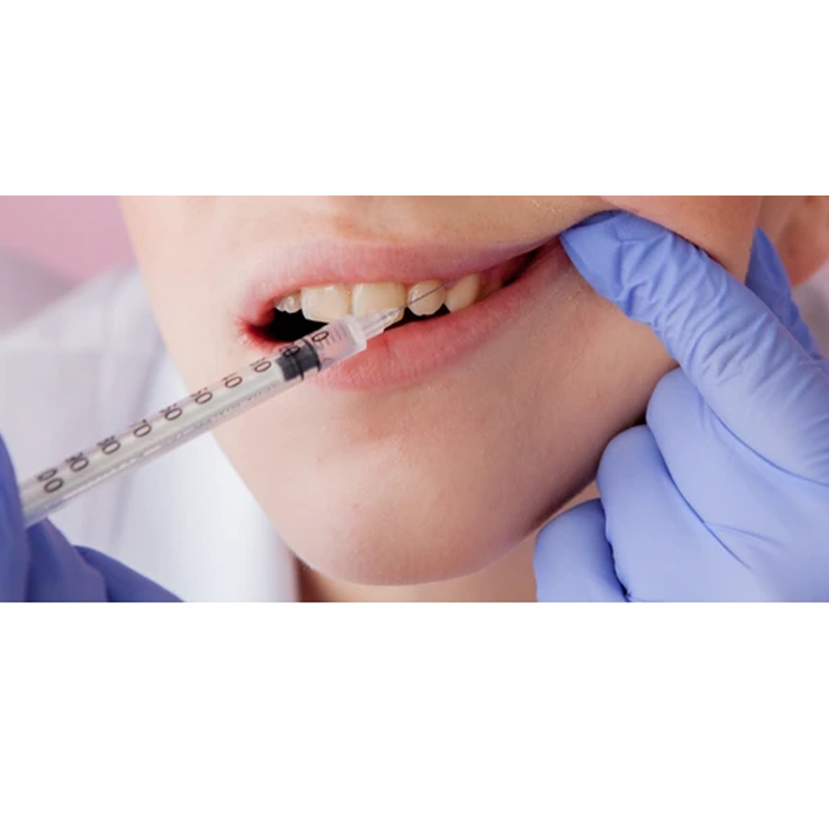 HMD Dispo Van Disposable Needle 30 Gauge | 1/2 Inch Length (Pack of 100)