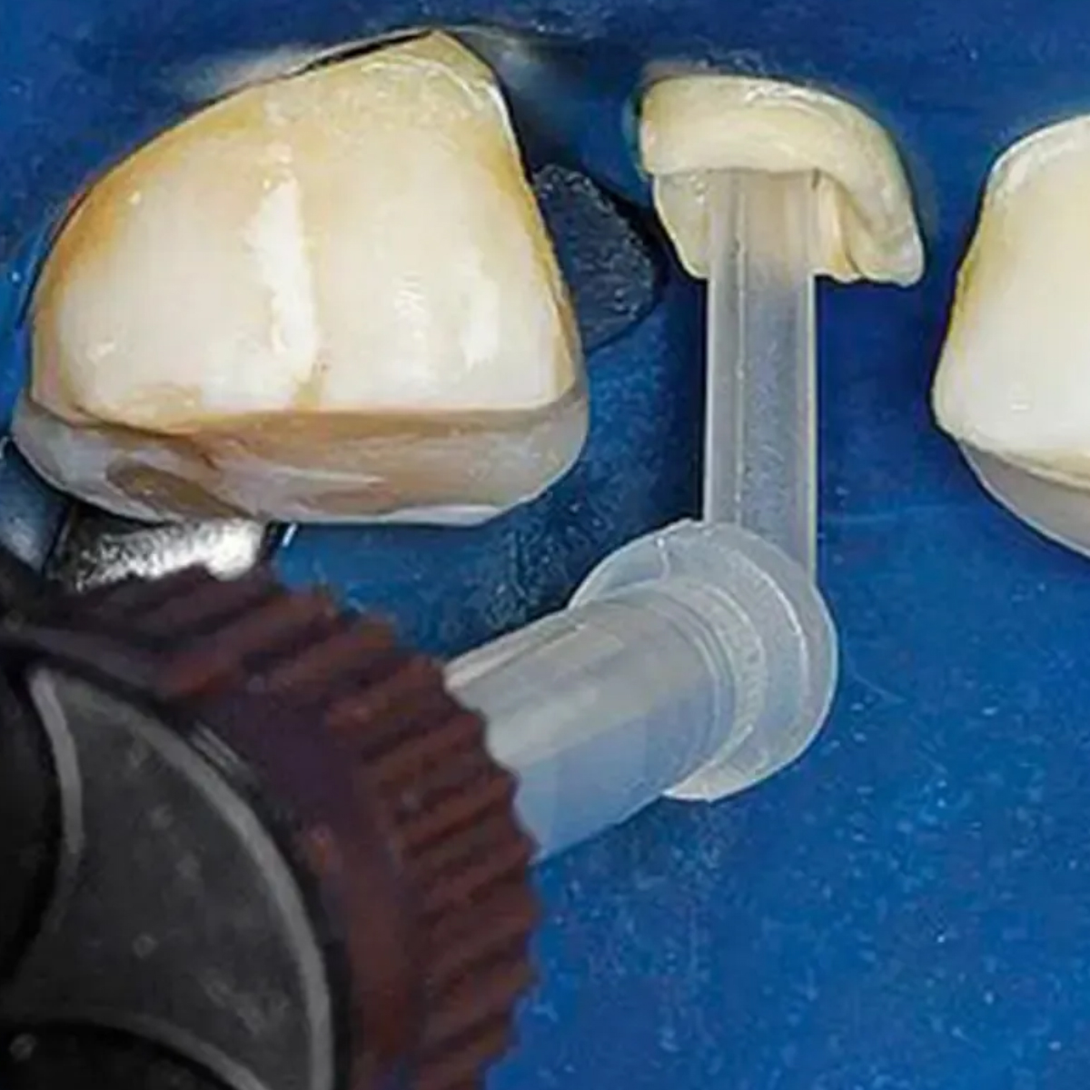 Wizdent Wonder Edge DC Core & Resin Cement Refills