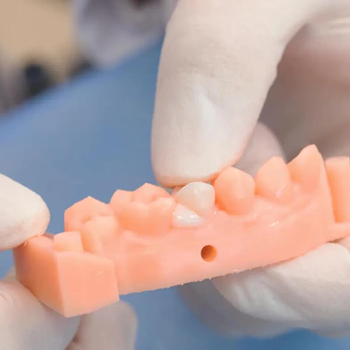 Wizdent Wonder Edge DC Core & Resin Cement Refills