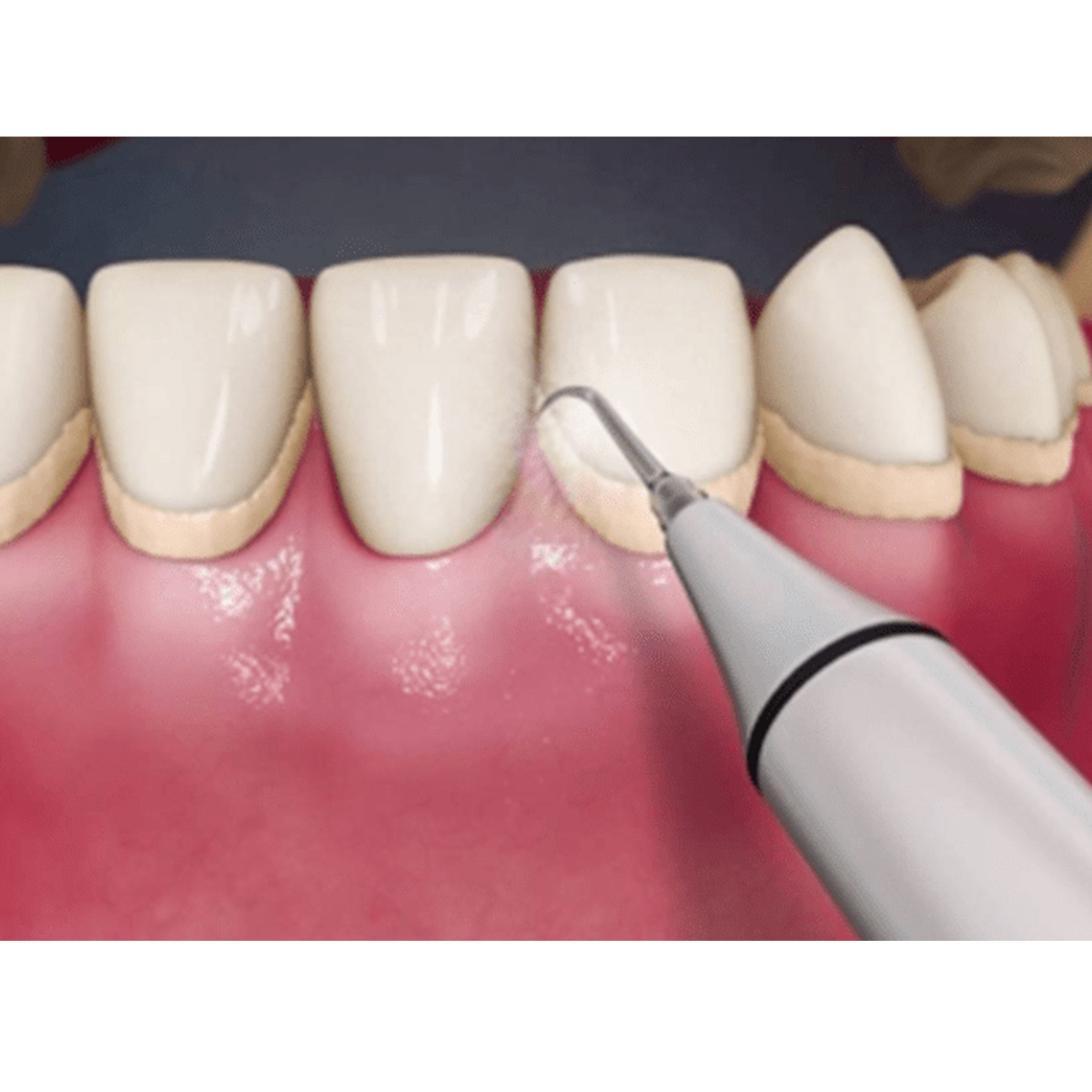 Woodpecker Scaler Tip G4 for UDS & EMS Scalers