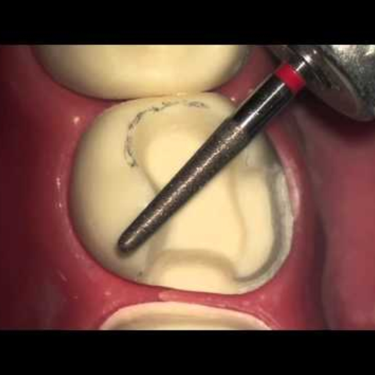 Pivo Inlay - Onlay Preparation Airotor Diamond Burs Kit (Set Of 10)          