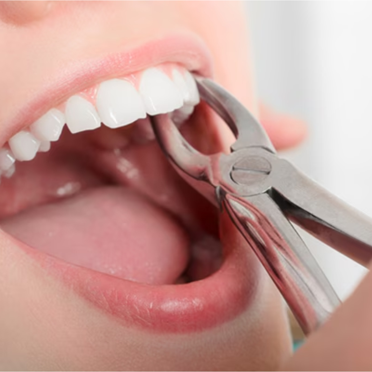 Medesy Upper Molar Extraction Forceps