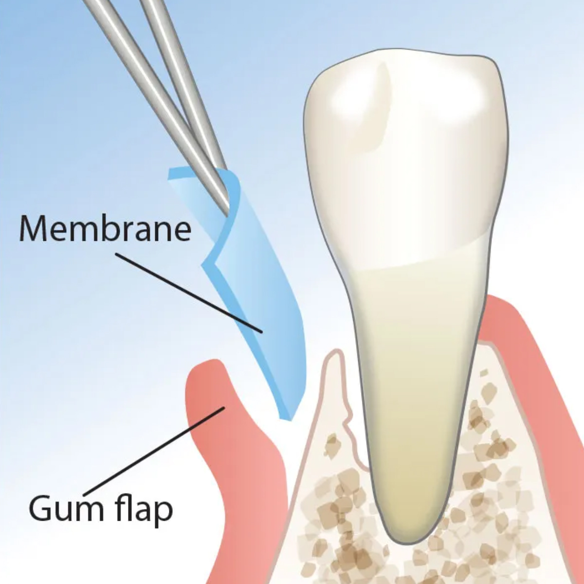 Advanced Biotech Healiguide Size - 15x20mm