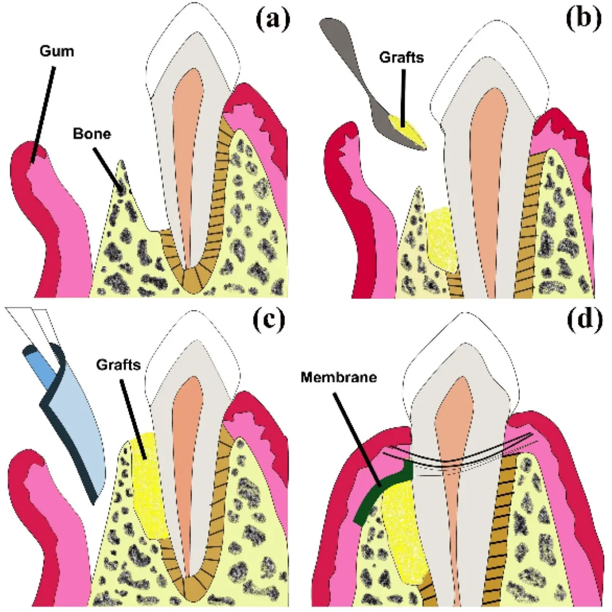 Advanced Biotech Healiguide Size - 15x20mm
