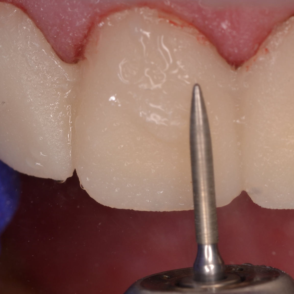 Pivo Porcelain Veneer Preparation Airotor Diamond Burs Kit (Set Of 6)