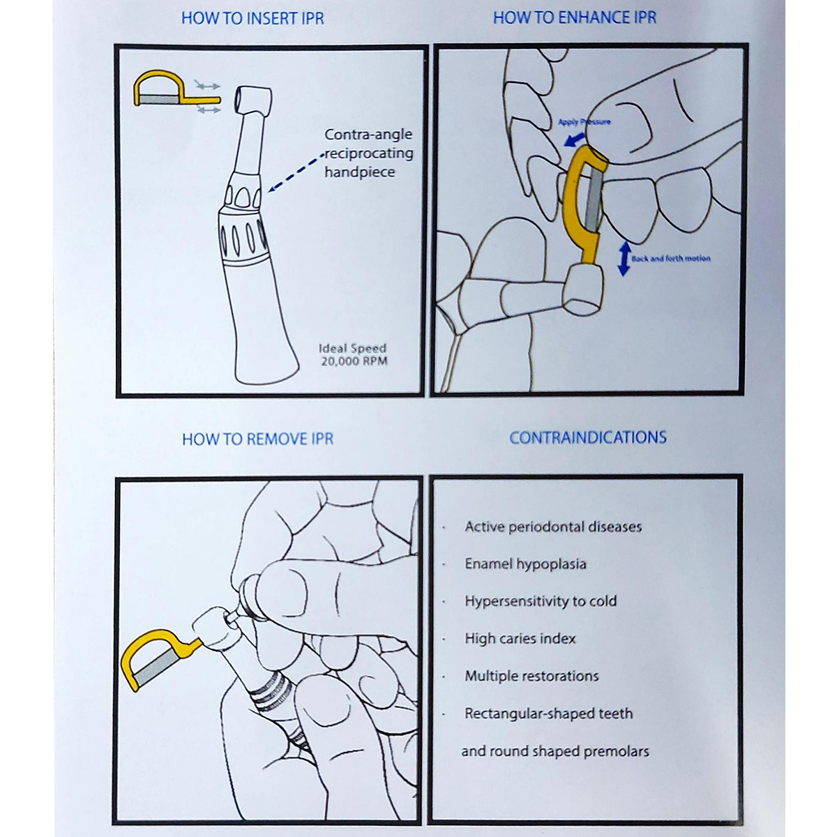 Sawbros Orthodontic IPR Blades Refill Set (Set of 12 Blades)