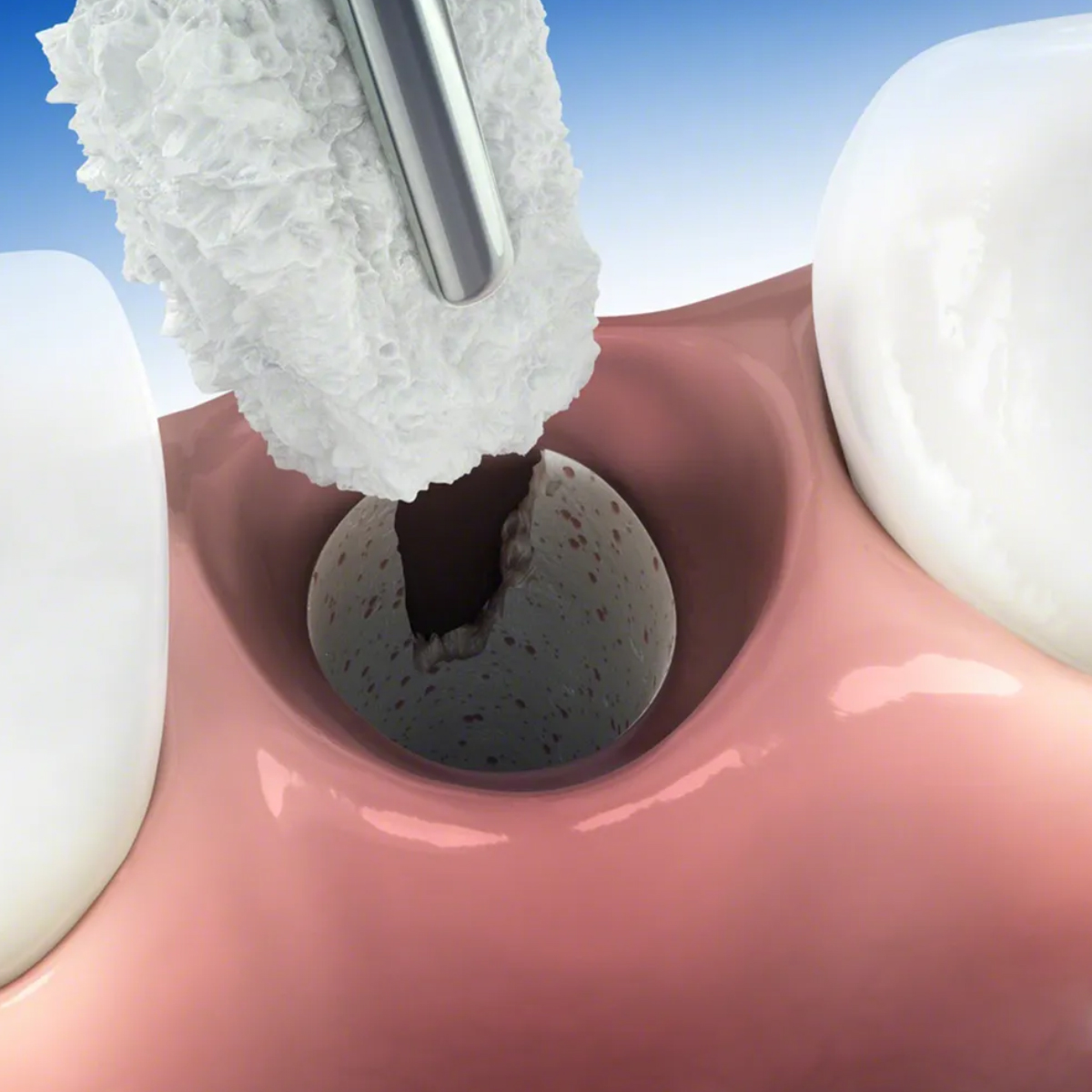 Geistlich Bio-Oss Collagen - 100mg