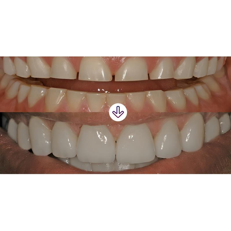 3M ESPE RelyX Veneer Cement Translucent