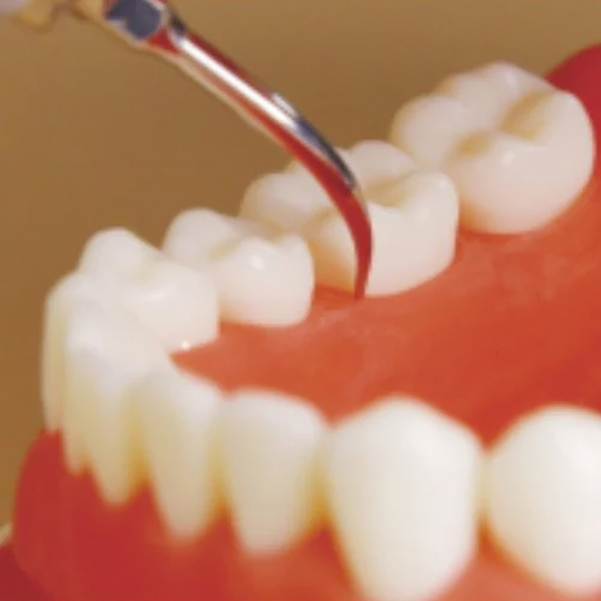 Woodpecker Scaler Tip G5 for UDS & EMS Scalers