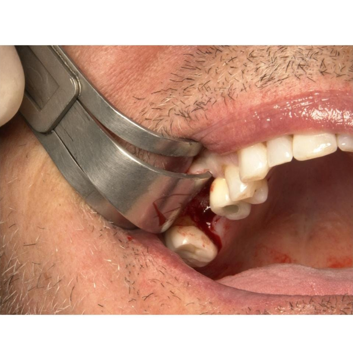 Julldent Dual Cheek & Flap Retractor