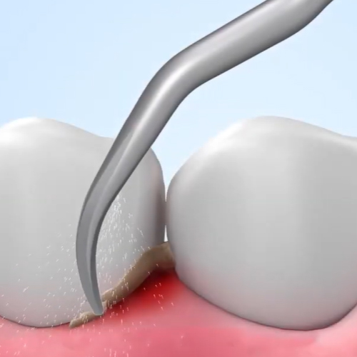 Woodpecker Scaler Tip G10 for UDS & EMS Scalers 