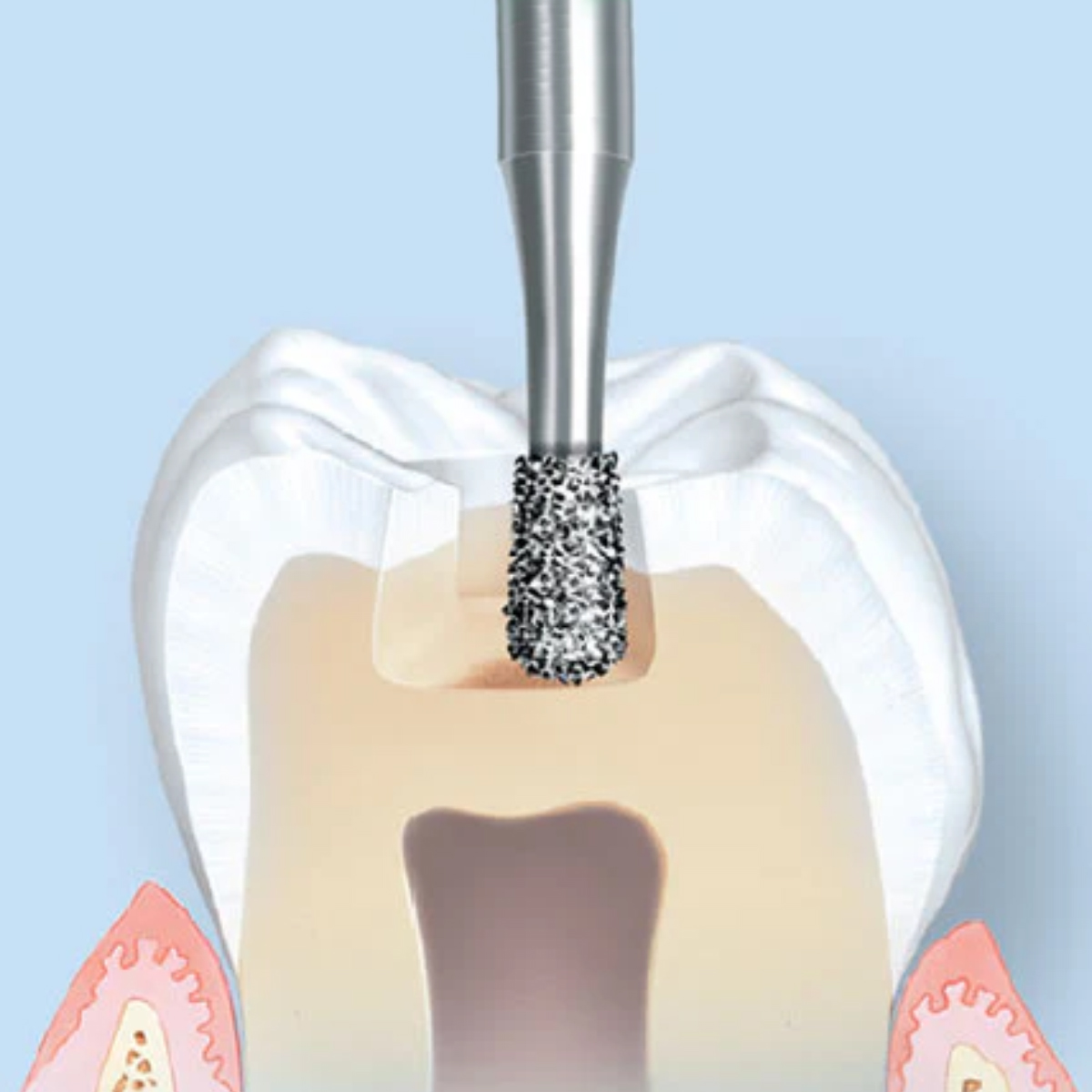 Pivo Extra Shape Contra-angle Diamond Burs CA - EX (Pack Of 5)