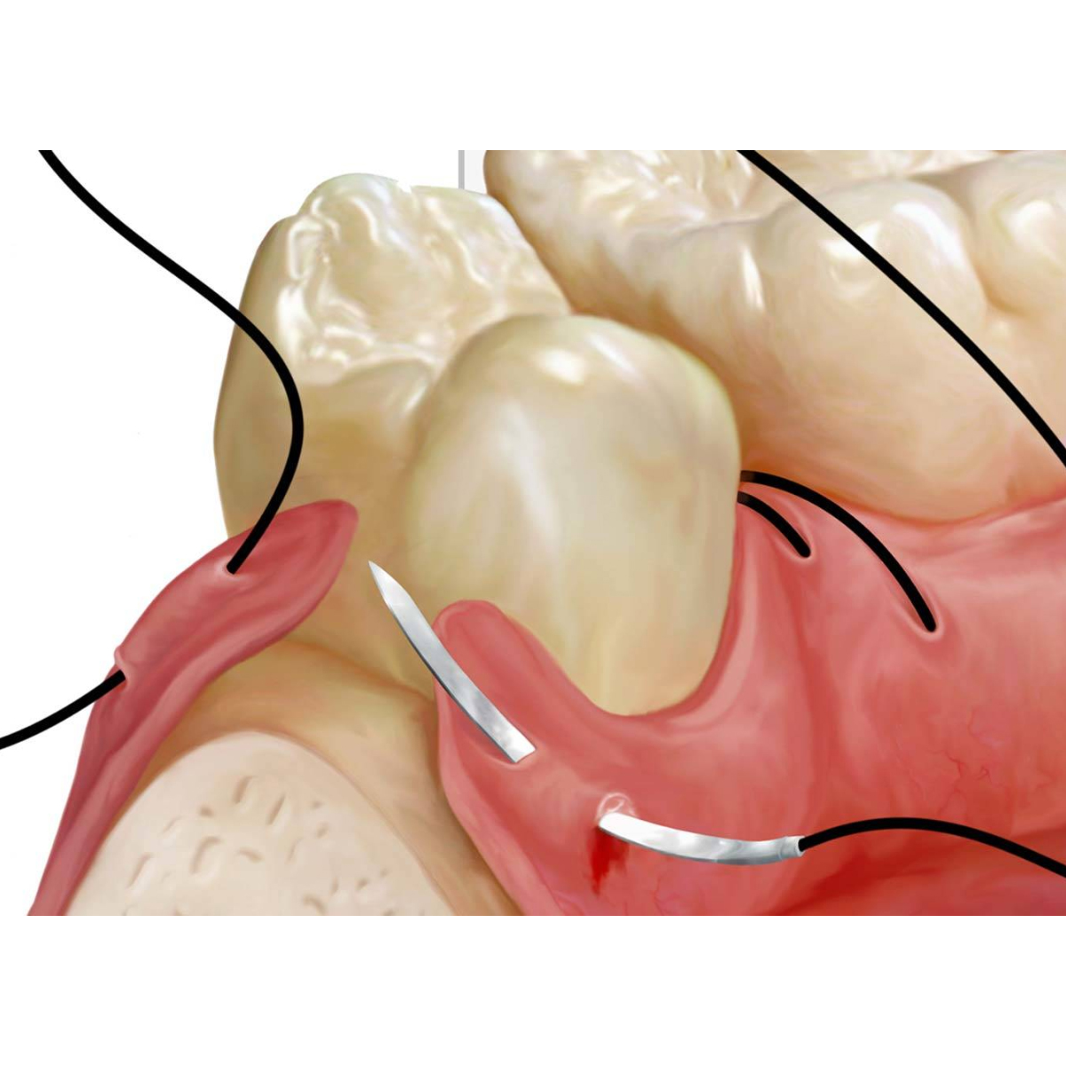 Dental Suture Practice Kit - Type II