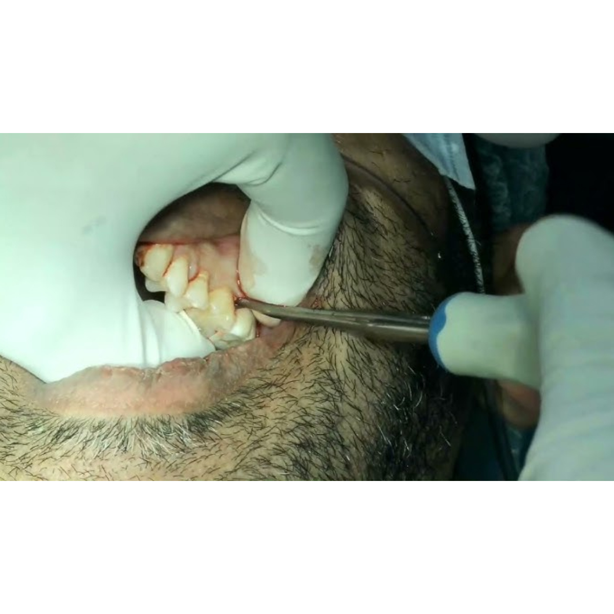 LM-LiftOut Luxating Instruments