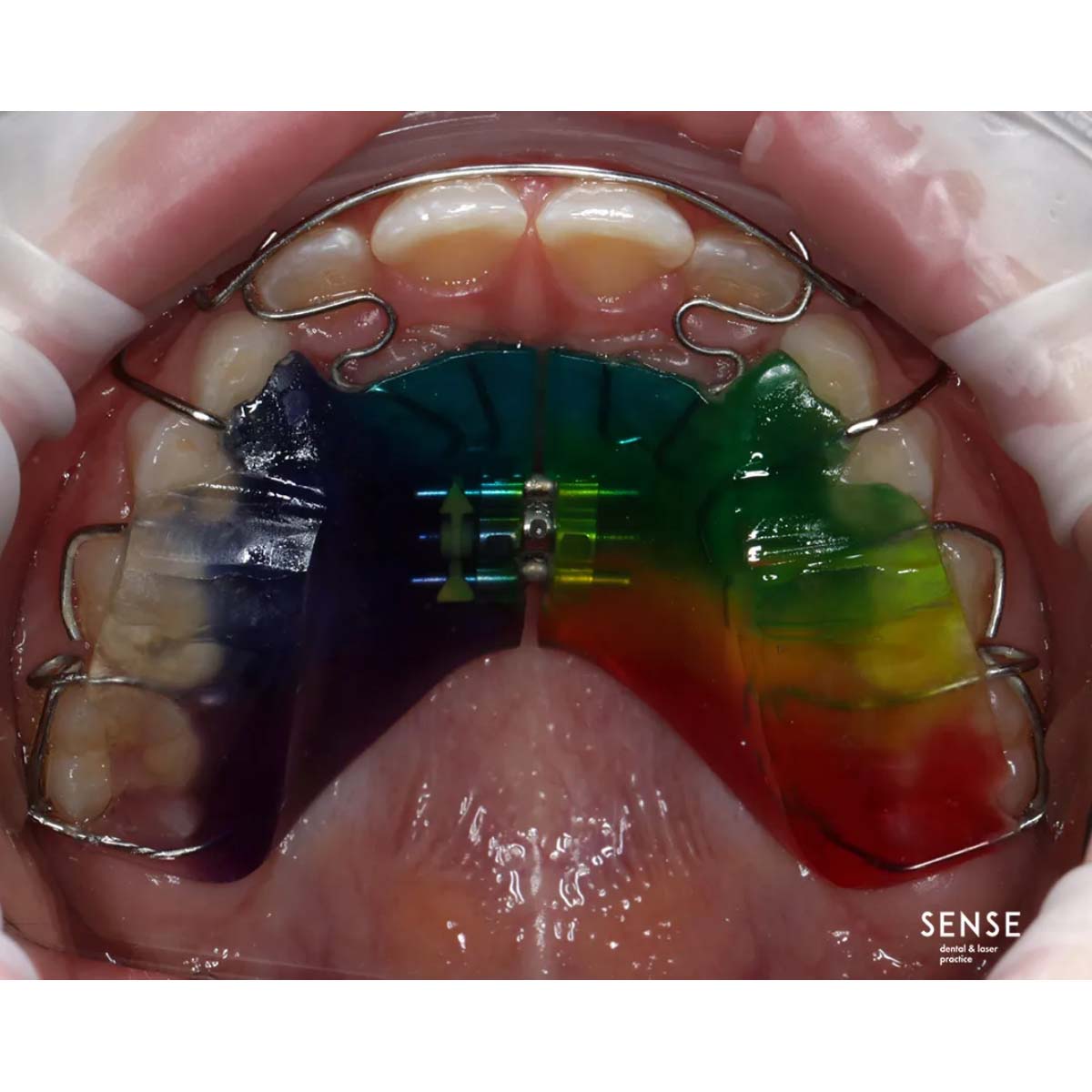 OrthoMetric SS CrNi Elastic Hard Wires Round In Roll 50gm