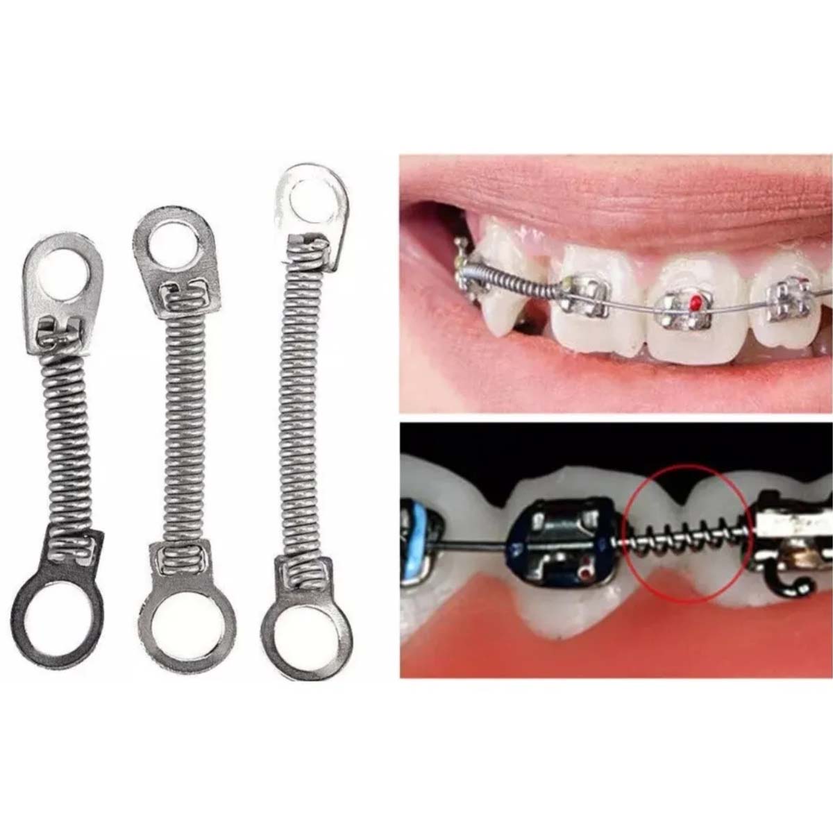 OrthoMetric Flexy NiTi Orthodontic Close Springs For Mini Screw