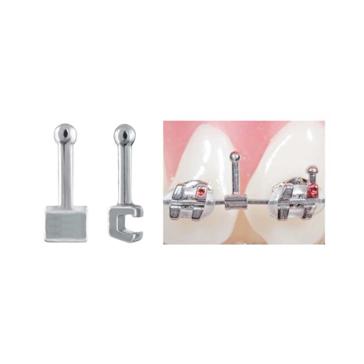 OrthoMetric Ball Point Straight Hook For Archwire - (30.10.2010)