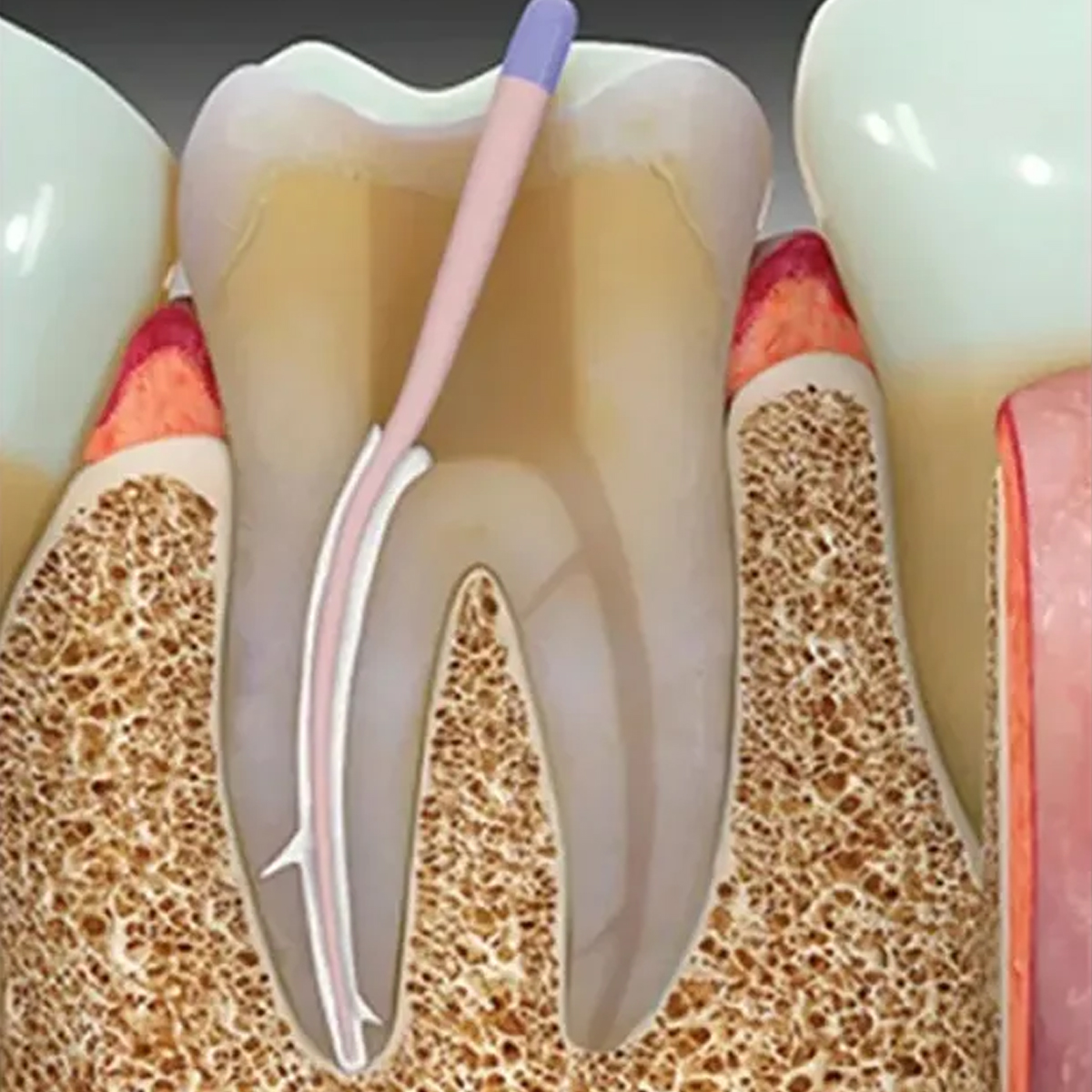 DPI Resinocem DC Dual Cure Resin Based Luting Cement
