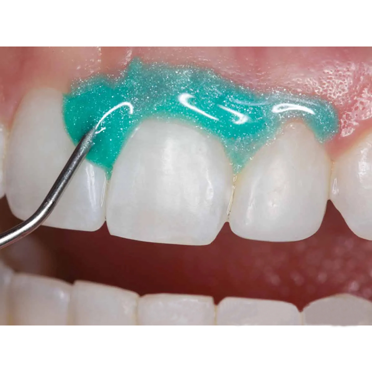 Prime Dental Gingisafe Light Cure Gingival Barrier Syringe