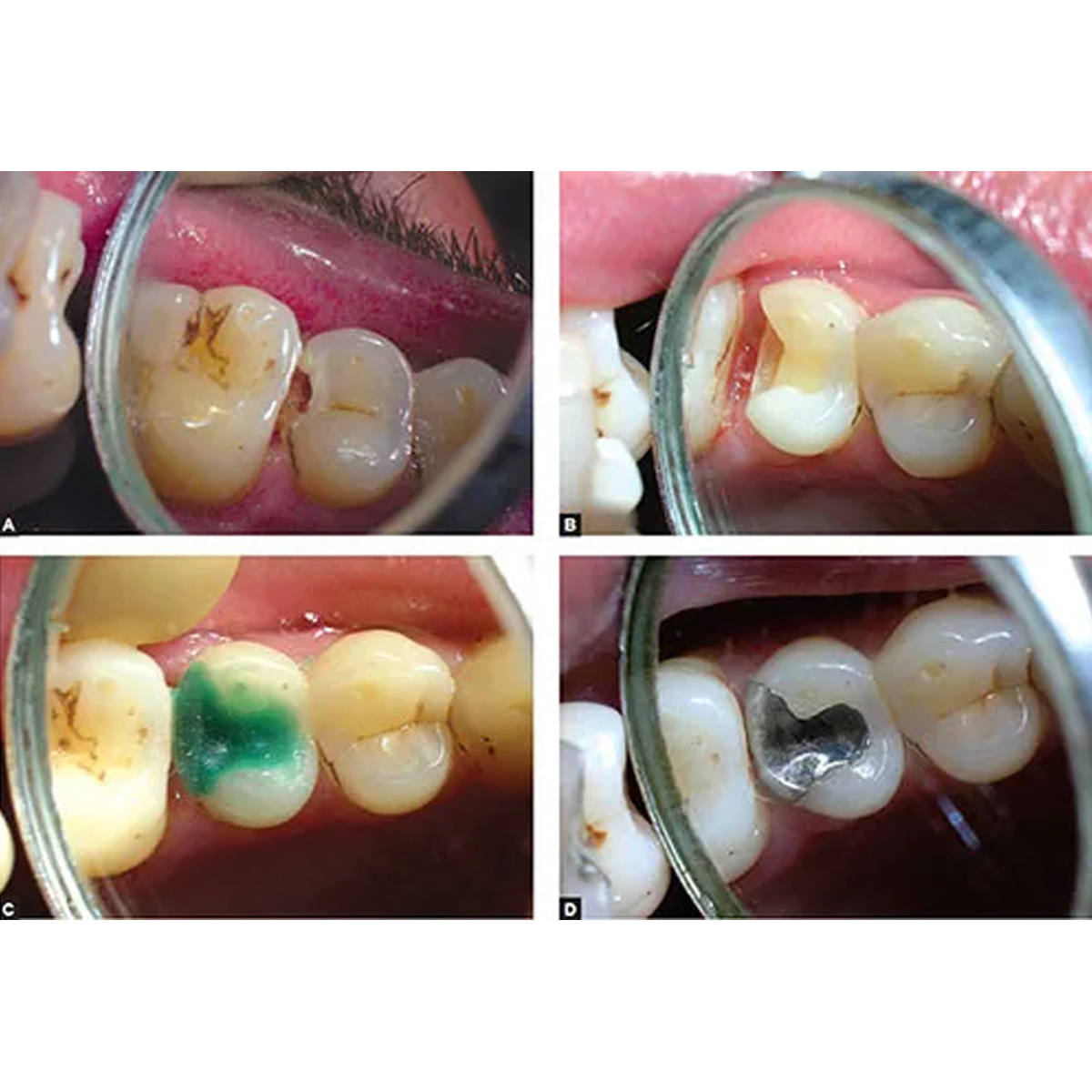 DPI BlueWax Pattern Wax