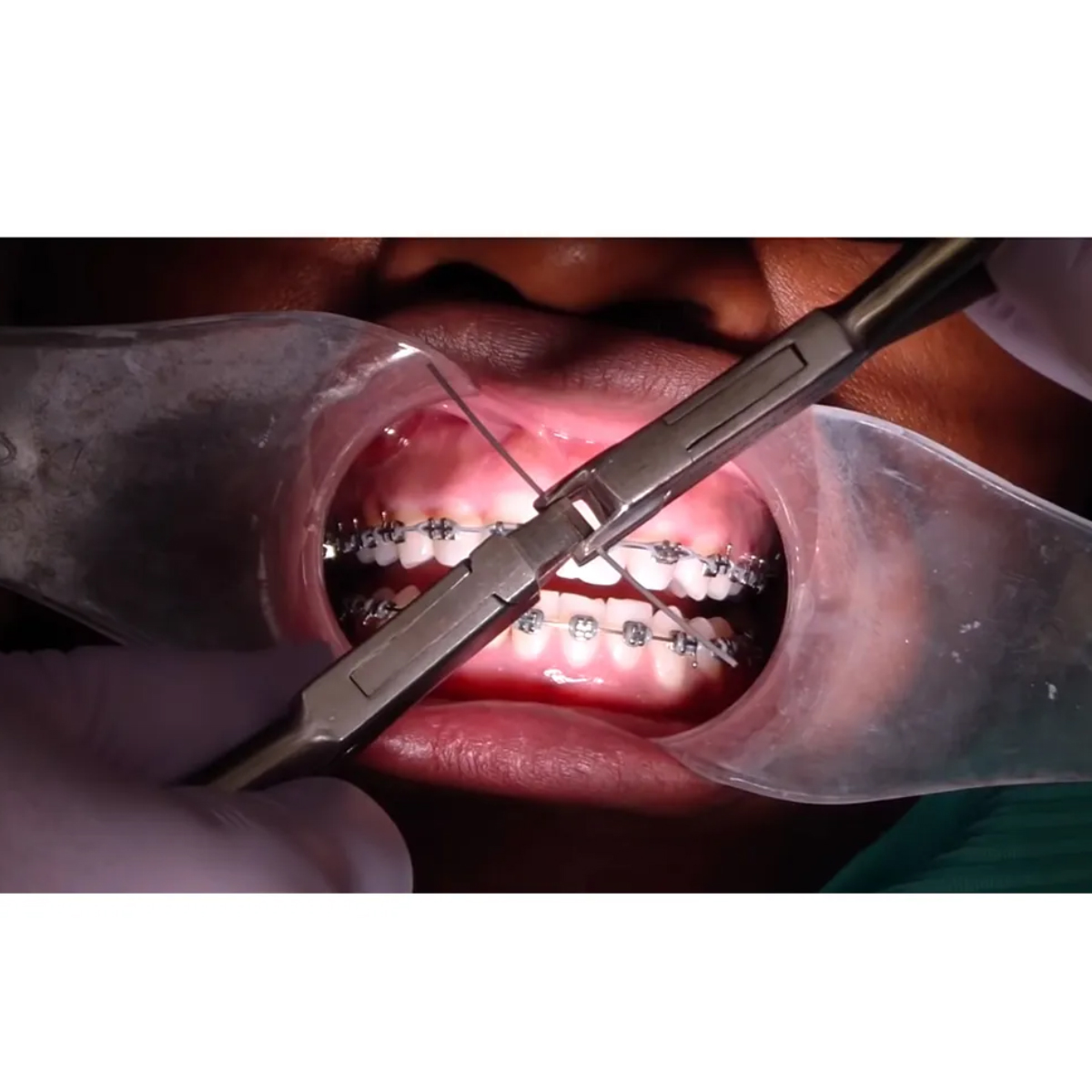 GDC Orthodontics Wire Bending Pliers Torquing Plier # Male (3000/19)