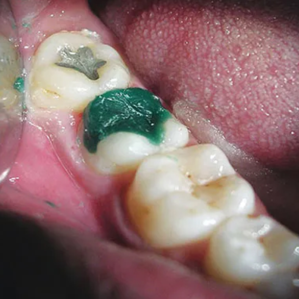 DPI BlueWax Pattern Wax