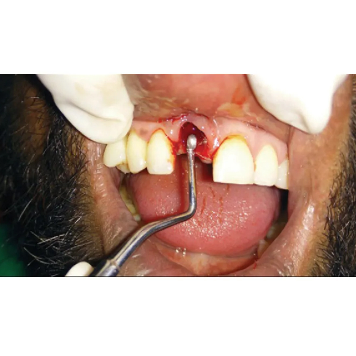 GDC Lucas Surgical Curette # 3 (CL84 # 3)